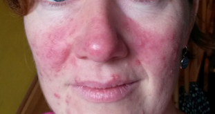 Rosacea 1